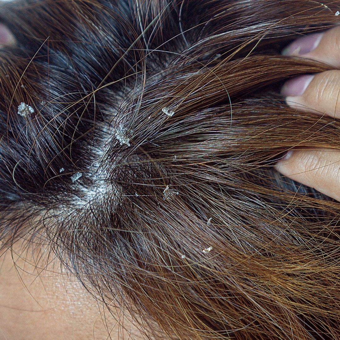 Dandruff: At Home Treatments That Work